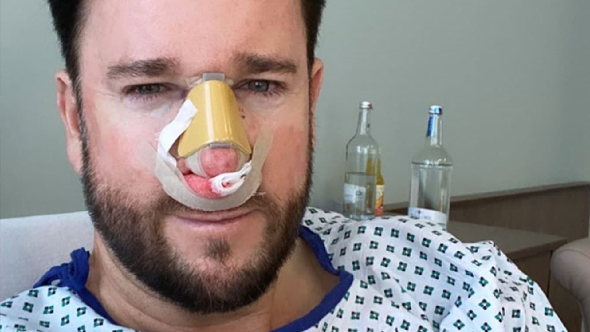 Michael Wendler Krasse Bilder Seiner Nasen Op