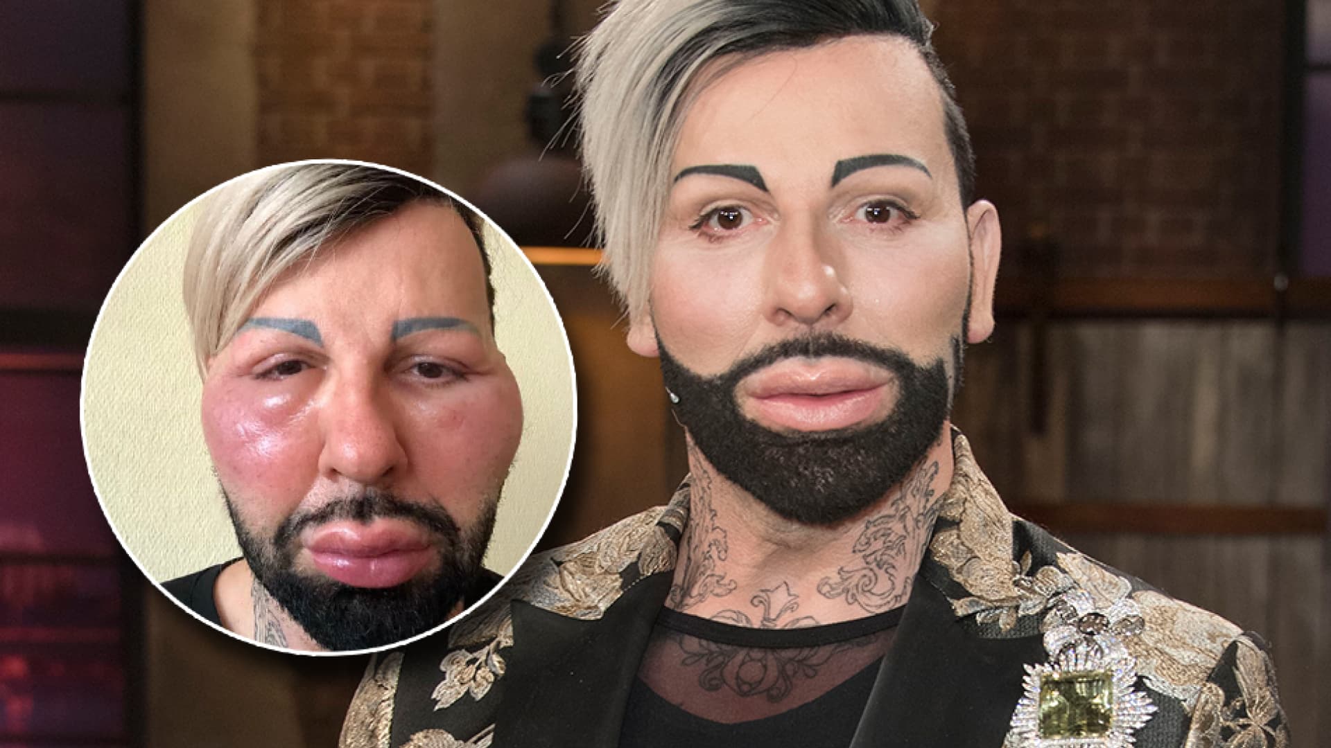 Harald Glööckler Was ist mit seinem Gesicht passiert? Harald Glööckler Was ist mit seinem Gesicht passiert?