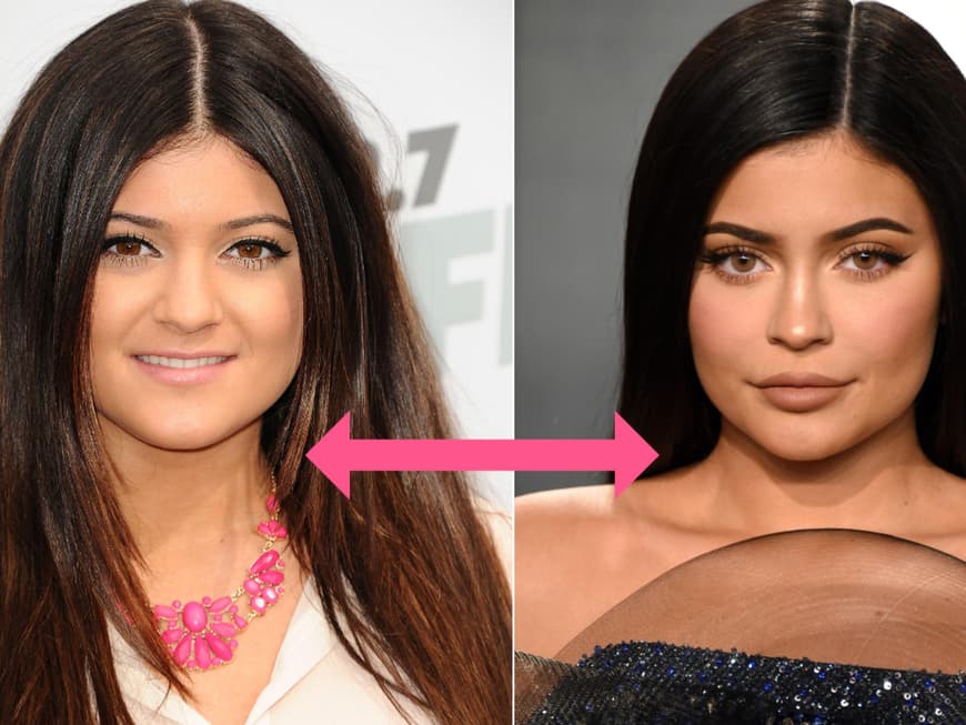 Schne Kylie Jenner Vorher Nachher Ebenbild
