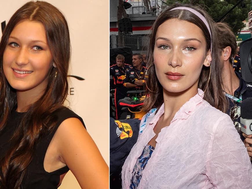Bella Hadid & Co. Diese PromiLadys hatten angeblich keine BeautyOPs!