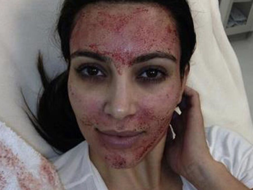 Wer schön sein will, muss bluten:´ Vampire Facelift" wird dieser kosmetische Eingriff von Kim Kardashian genannt, bei dem Blut  aus dem Arm entnommen wird, auf eine gelartige Plasmasubstanz reduziert  wird und zurück ins Gesicht gespritzt wird