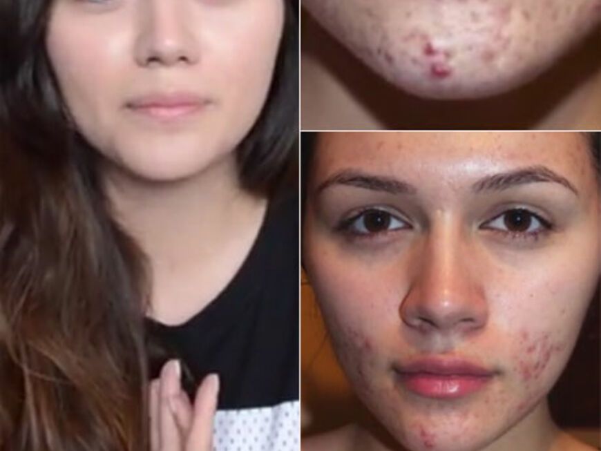 Anna Maria Damm berichtet über ihre Probleme mit Akne