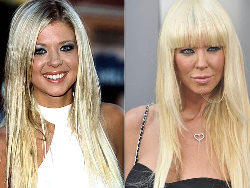 Pamela Anderson vorher und nachher