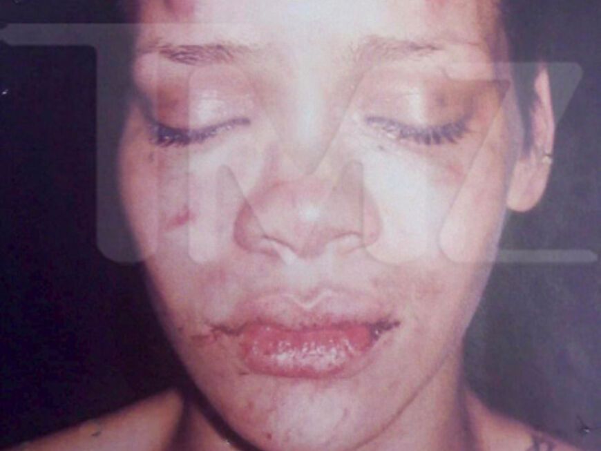 Erschreckende Bilder: Rihanna mit Wunden und blauen Flecken im Gesicht. Das Ergebnis von Chris' brutalem Übergriff