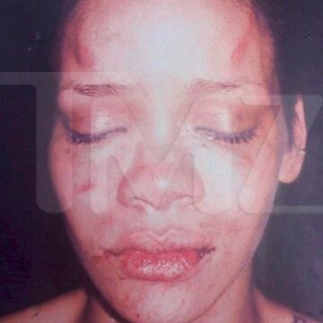 Die Sängerin erlitt schwere Verletzungen im Gesicht. Und nicht nur das, auch ihre Seele hat monatelang unter der brutalen Attacke ihres Ex-Freundes gelitten