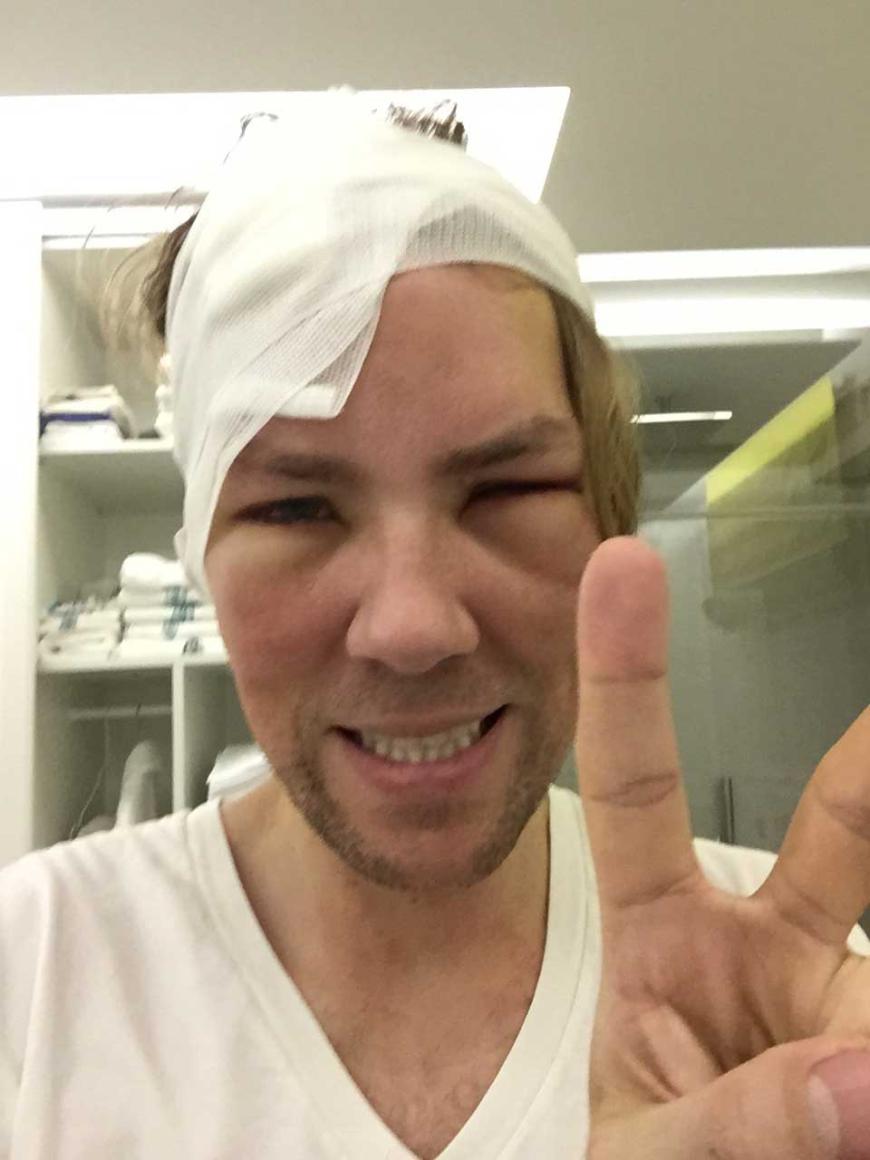 Mit Einer Blutplasma Unterspritzung Jens Hilbert Wie Schon Mussen Manner Sein Ok Magazin