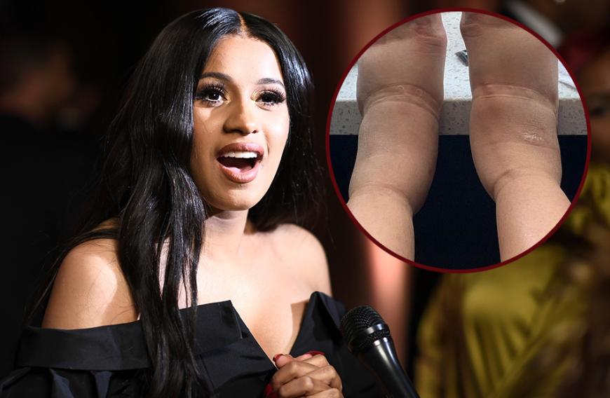 Cardi B Schock Foto Was Ist Mit Ihren Fussen Passiert