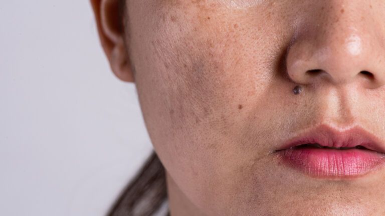 Frau mit Pigmentflecken im Gesicht